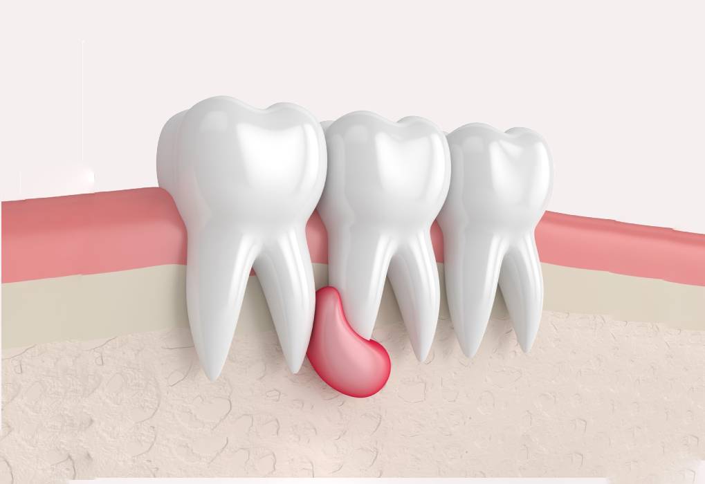 Лечение кисты зуба хирургическое