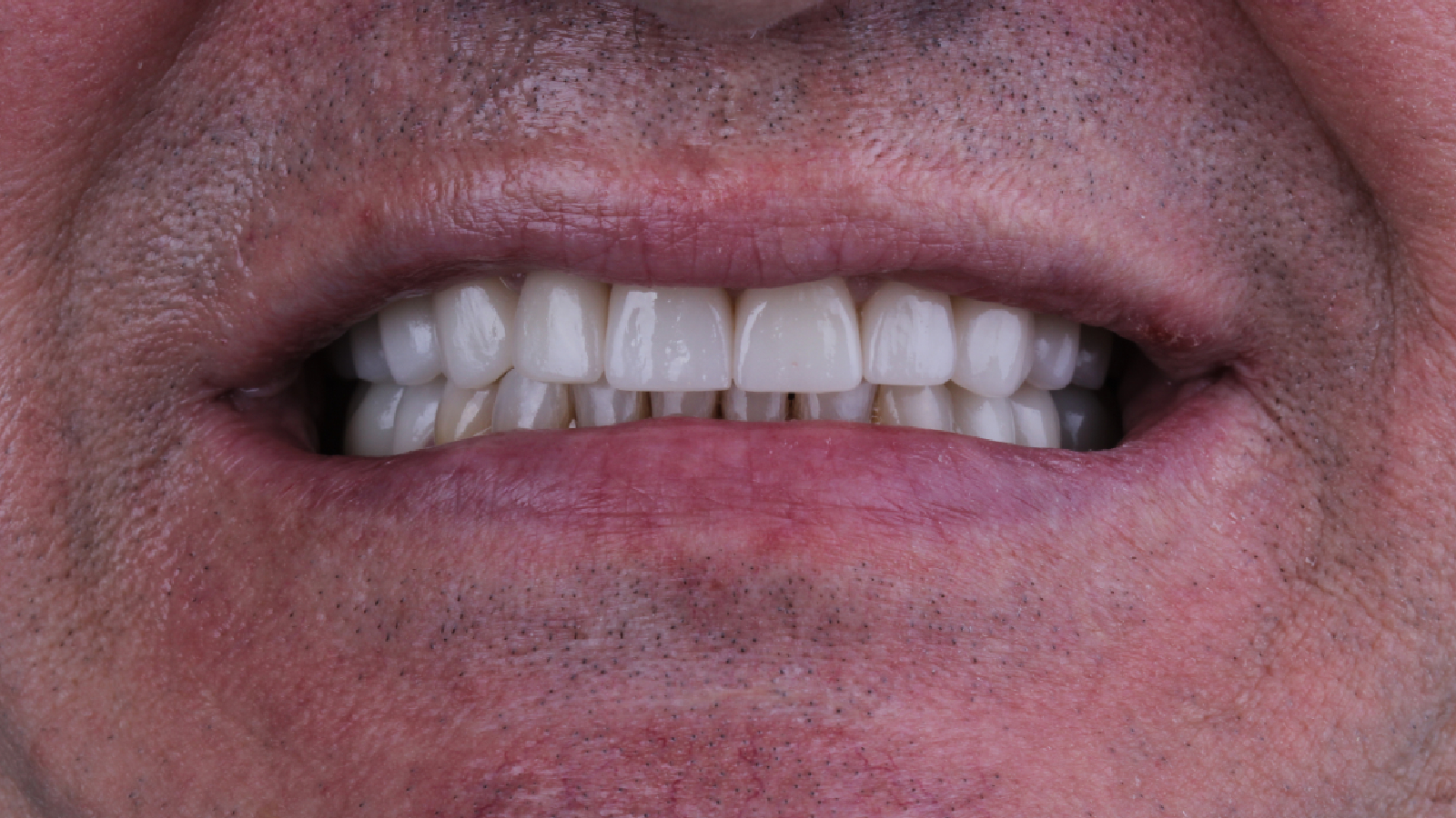 Восстановление патологической стираемости своих зубов