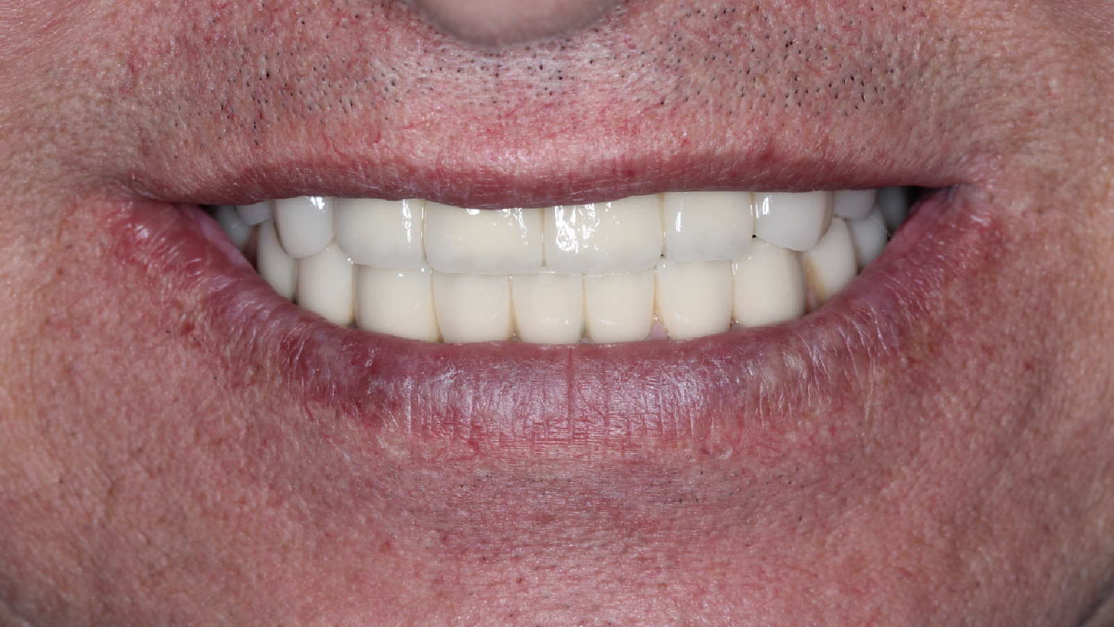 Восстановление патологической собираемости своих зубов