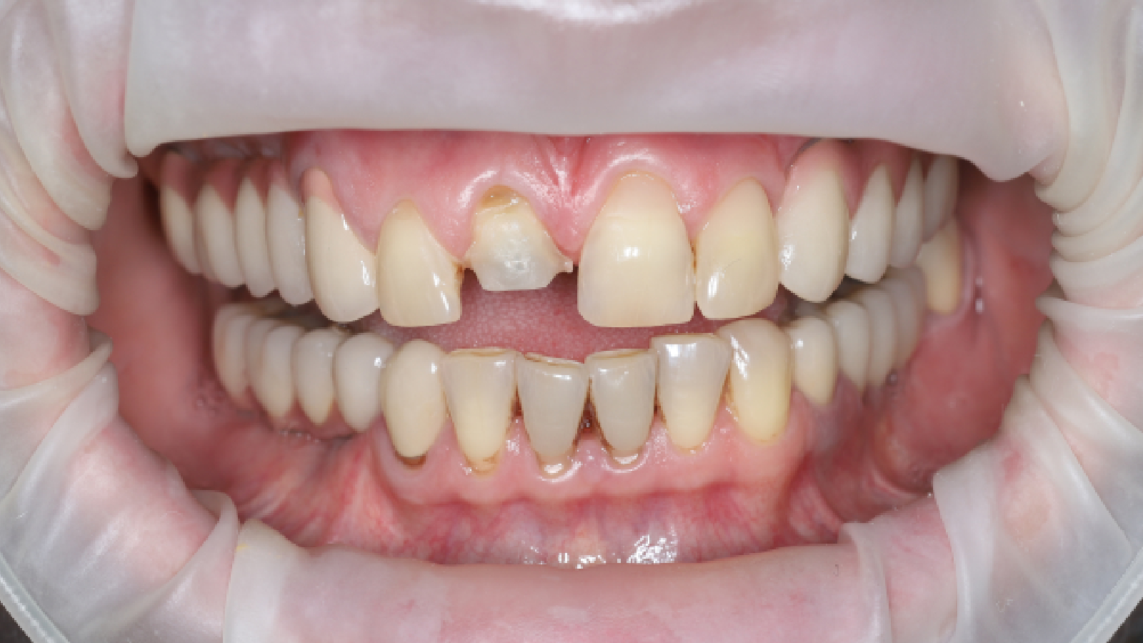 Восстановление культи зуба и установка коронок